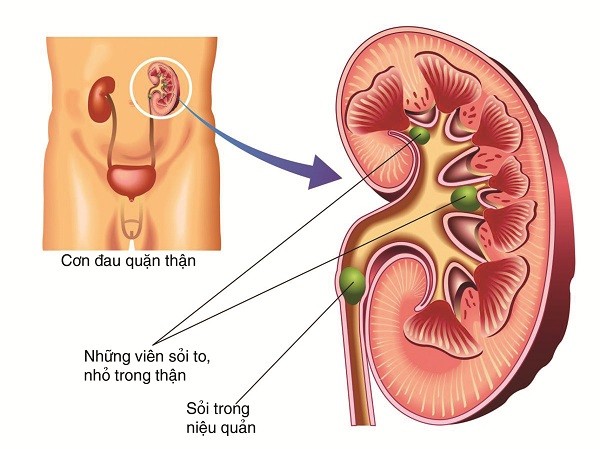 “Tan Sỏi, Lợi Thận” Bằng Cách Nào? 3 2020