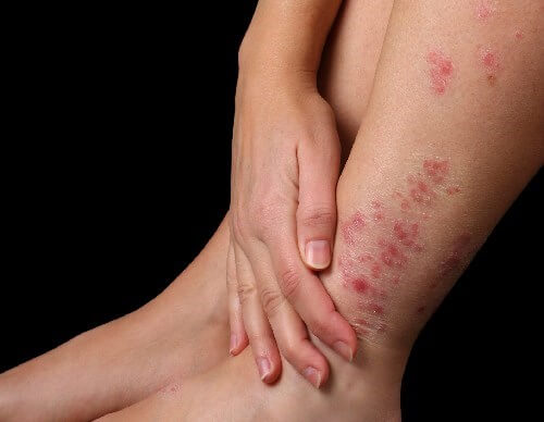 Photo of Đá Muối Himalaya: Mẹo Hay Trị Ngay Vảy Nến