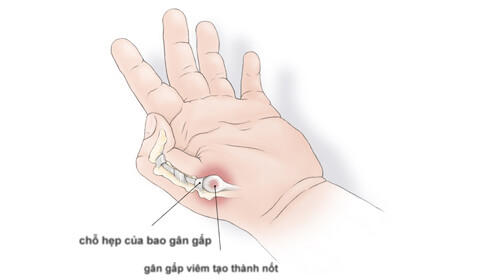Đá Muối Hồng Có Trị Hết Bệnh Viêm Bao Gân Tay Chân Không? 2 2020 Đá Muối Hồng Có Trị Hết Bệnh Viêm Bao Gân Tay Chân Không? 1 2020