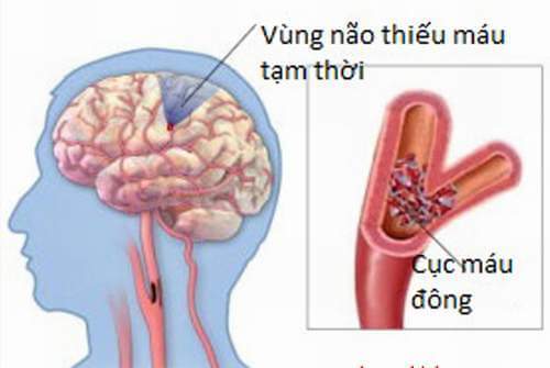 Chứng Tê Nhức Đầu Ngón Tay - Có Trị Được Không? 3 2020 Chứng Tê Nhức Đầu Ngón Tay - Có Trị Được Không? 3 2020
