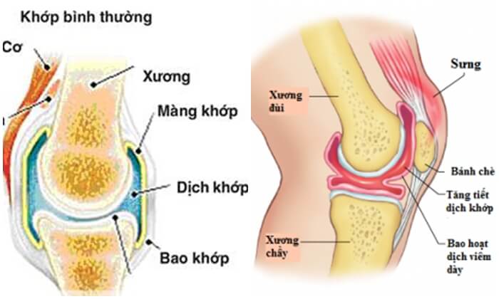 Giảm Đau Nhức Chứng Viêm Bao Hoạt Dịch 1 2020