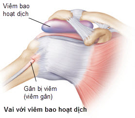 Giảm Đau Nhức Chứng Viêm Bao Hoạt Dịch 2 2020