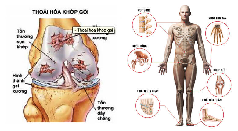 Tê Tay Ở Người Lớn Tuổi Có Phải Là Bệnh Tuổi Già 4 2020