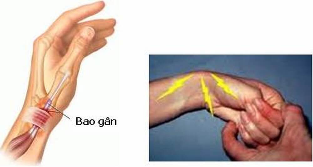 Các cách điều trị viêm bao da vùng mõm trâm quay không dùng thuốc