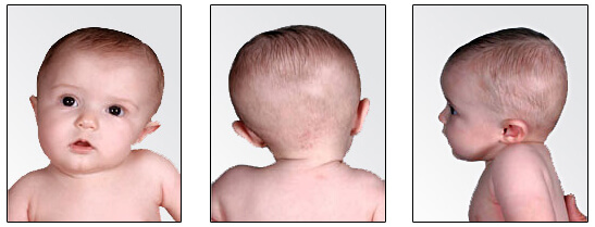 Vẹo đốt sống cổ: Trị ngay trước khi tạo ra hệ lụy 4 2020 Vẹo đốt sống cổ: Trị ngay trước khi tạo ra hệ lụy 4 2020
