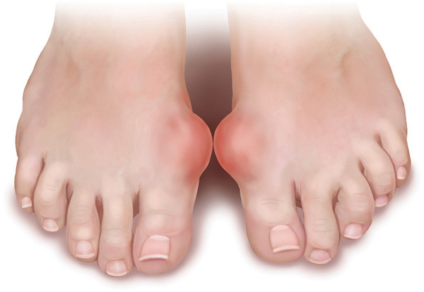 Bệnh Gút (Gout) Nên Ăn Gì? 1 2020 Bệnh Nhân Bị Bệnh Gút Nên Ăn Gì