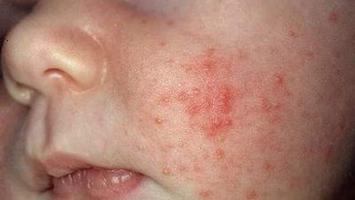Bệnh Kê Ở Trẻ Nhỏ: 10 Vấn Đề Cần Lưu Ý Khi Điều Trị 7 2020 Ảnh của