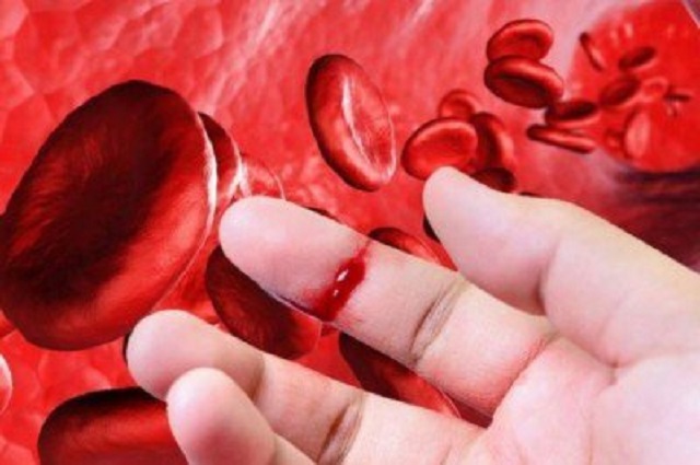 Bệnh Máu Khó Đông Ở Trẻ Em: 5 Cách Phòng Ngừa Bệnh Máu Khó Đông 3 2020 Bệnh Máu Khó Đông Ở Trẻ Em: 5 Cách Phòng Ngừa Bệnh Máu Khó Đông 3 2020