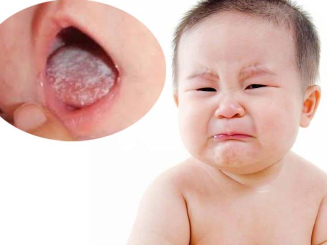Thuộc Lòng 6 Thông Tin Cơ Bản Về Bệnh Nấm Lưỡi Ở Trẻ Em 4 2020 Danh sách các bác sĩ chuyên trị Bệnh Nấm Lưỡi Ở Trẻ Em
