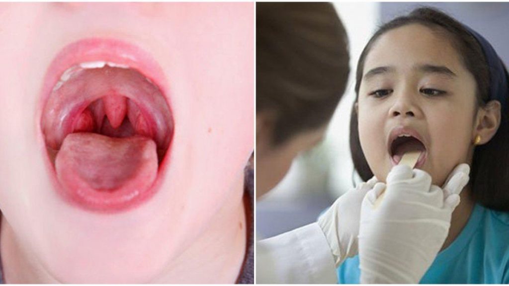 Top 5 Cách Chữa Viêm Amidan Ở Trẻ Tại Nhà Đơn Giản, Không Dùng Thuốc 2 2020 Cách chữa amidan hiệu quả nhất