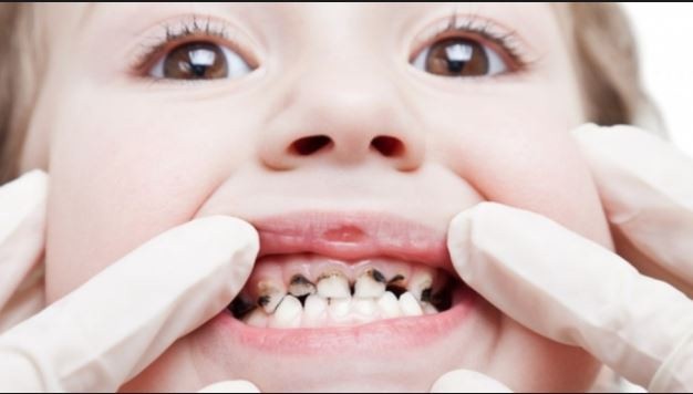 Cách Phòng Ngừa, Điều Trị: 05 Loại Bệnh Răng Miệng Ở Trẻ 3 2020