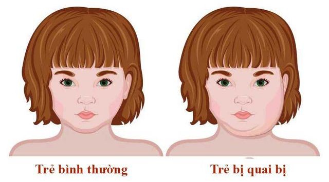 Cách Phòng Ngừa Bệnh Quai Bị Ở Trẻ và Triệu Chứng Bệnh 1 2020